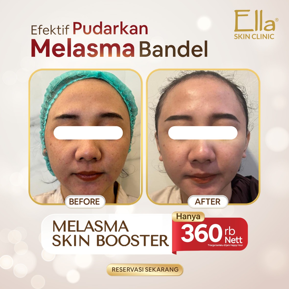 Noda hitam di wajah bisa jadi MELASMA 😱